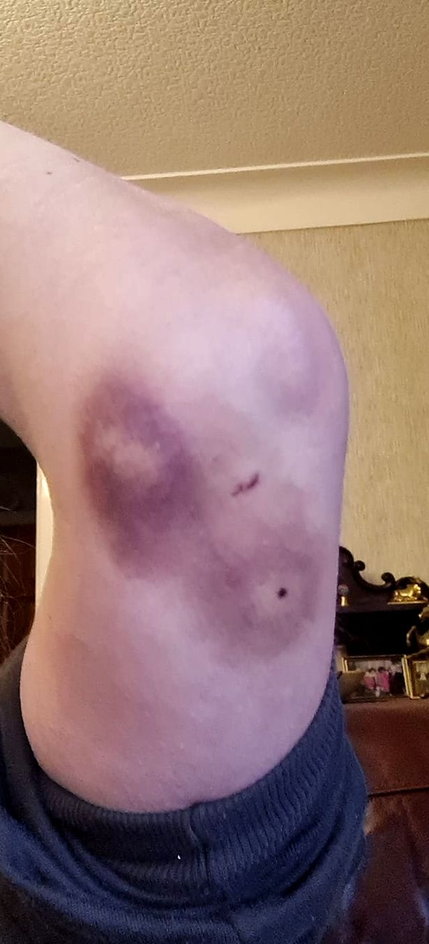 Buckley resident Jane Harry was left badly bitten and bruised after an encounter with Stripe